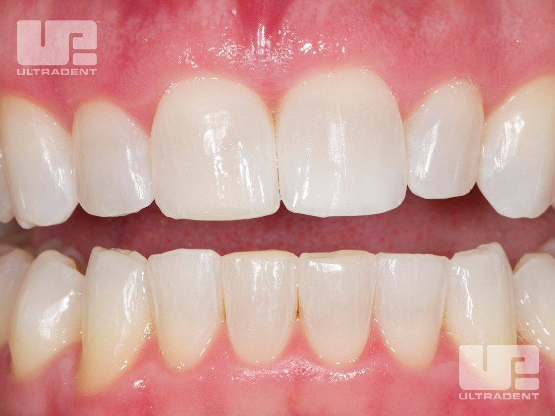 Nachher-Foto des Herstellerbeispiels nach 30 Tagen mit Opalescence Custom 10 Prozent; Fotos Carol Jent, RDH
