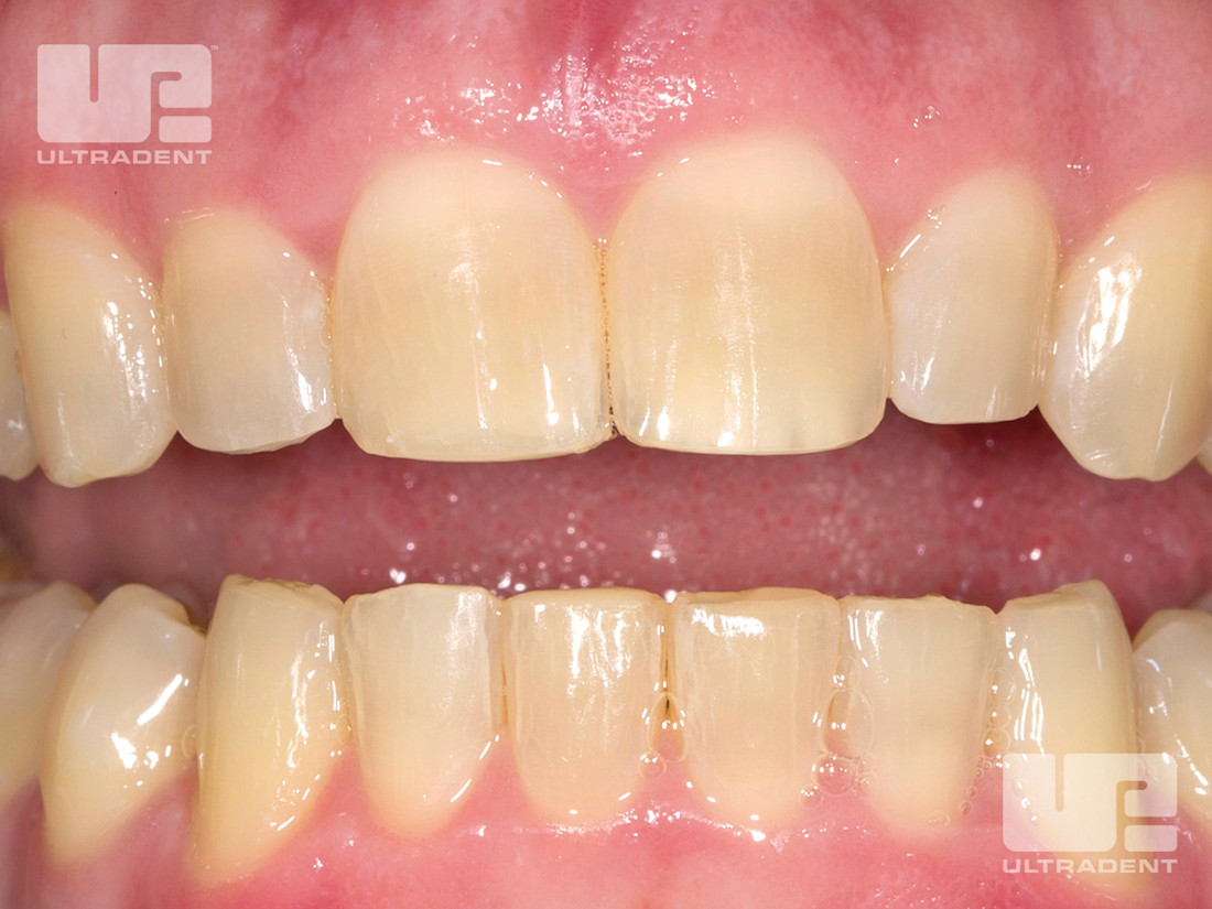 Vorher-Foto des aktuellen Ultradent-Herstellerbeispiels von Carol Jent, RDH