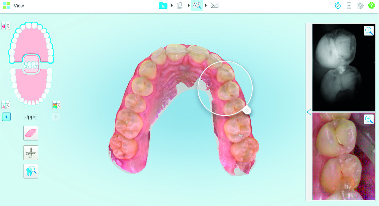 iTero-Herstellerbeispiel: 3D-Ansicht eines oberen Zahnbogens mit Kamerabild und NIRI-Aufnahme einer markierten Kontaktstelle